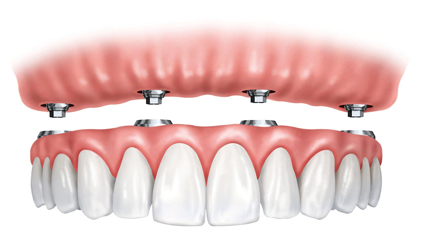 Temporary teeth fixed on Implant